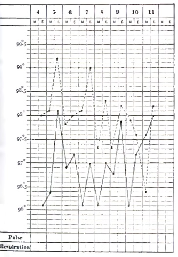 Temperature chart of hemiplegia