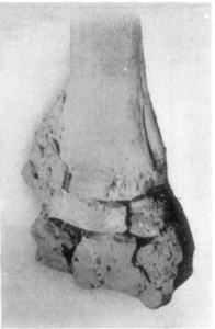 Fig. 15—Distal end of radius. Illustrating the effects of chronic carpitis.