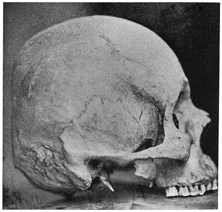 Fig. 8. Navaho skull, flattened at occiput. Hyperbrachycephalic. Length-breadth index, 96.93.