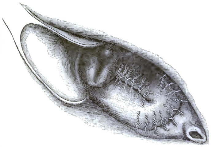 Descent of the uterus